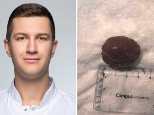 Лекари от Пловдив спасиха пациент след заседнала костилка в хранопровода